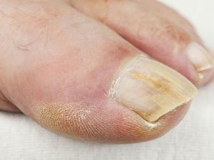 Грибкові та негрибкові захворювання нігтів на руках та ногах та їх причини