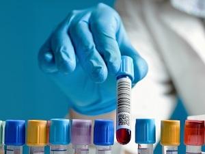 Kako napraviti test krvi na hormone štitnjače T3 SV \ T4 SV, TSH